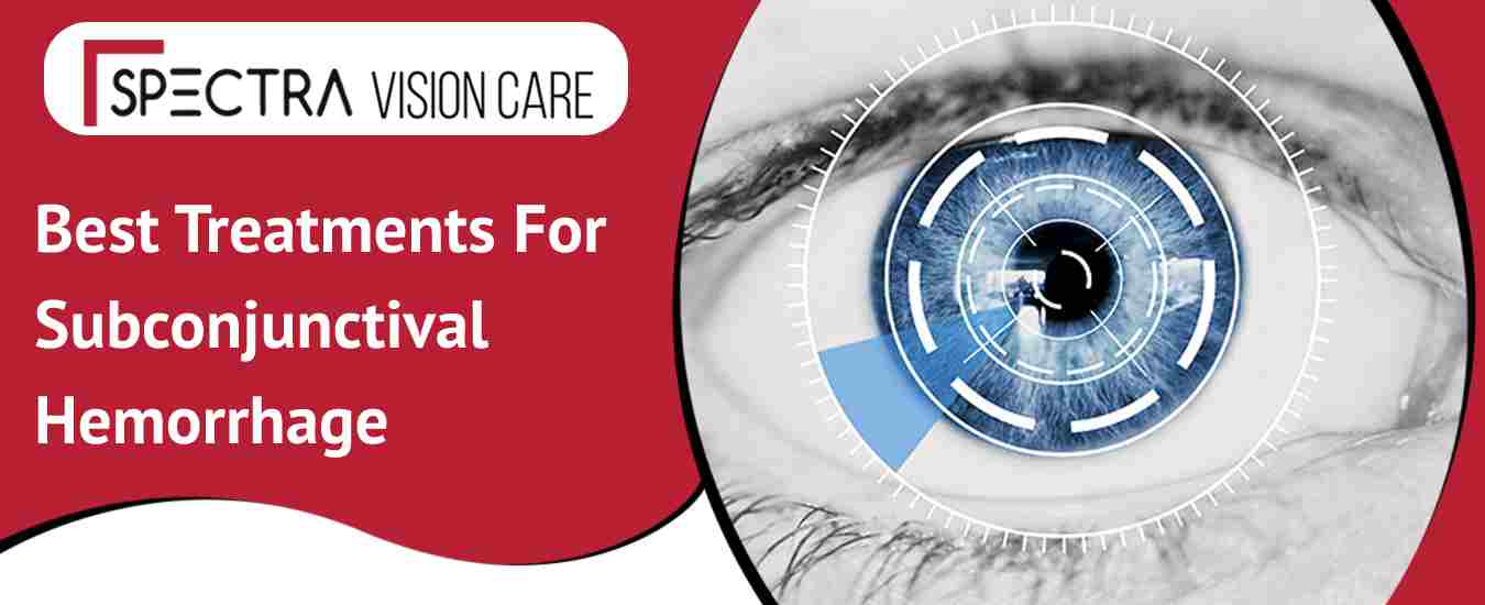 Best Treatments For Subconjunctival Hemorrhage In India
